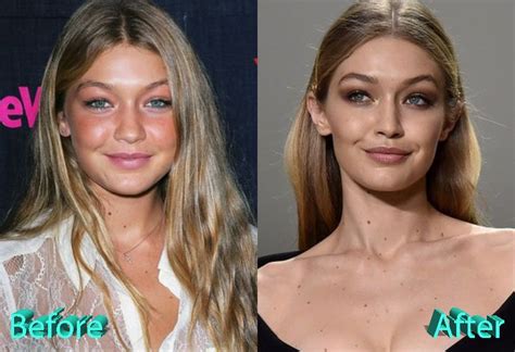 gigi hadid plastic surgery|Gigi Hadid Opened Up About How Pregnancy Has。